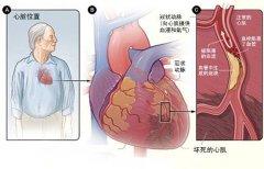 冠心病的起因是什么？